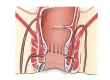 Fistula Operation in Mumbai