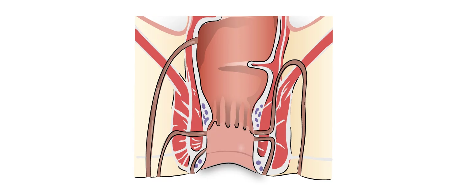 Fistula Operation in Mumbai