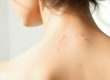Sebaceous Cysts in Dombivli