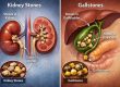 Kidney Stones and Gallstones