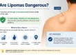 Are Lipomas Dangerous?