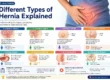 Different Types of Hernia Explained