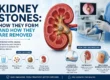 Kidney Stones How They Form and How They Are Removed