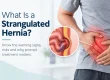 Strangulated Hernia Warning Signs